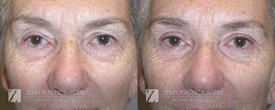 Blepharoplasty / Browlift Before & After Gallery - Patient 106400566 - Image 1