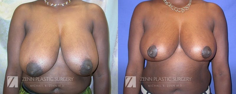 Breast Reduction Before & After Gallery - Patient 106400567 - Image 1