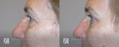 Blepharoplasty / Browlift Before & After Gallery - Patient 106400566 - Image 2