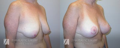 Breast Lift + Implants Before & After Gallery - Patient 106400565 - Image 2