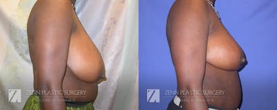 Breast Reduction Before & After Gallery - Patient 106400567 - Image 2