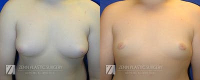 Gynecomastia Before & After Gallery - Patient 106400568 - Image 1