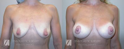 Breast Lift + Implants Before & After Gallery - Patient 106400570 - Image 1