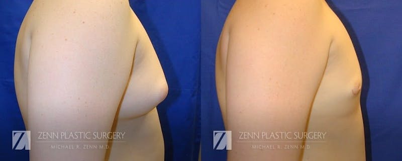 Gynecomastia Before & After Gallery - Patient 106400568 - Image 2
