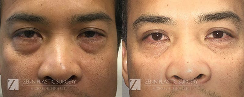 Blepharoplasty / Browlift Before & After Gallery - Patient 106400569 - Image 1