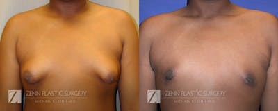 Gynecomastia Before & After Gallery - Patient 106400572 - Image 1