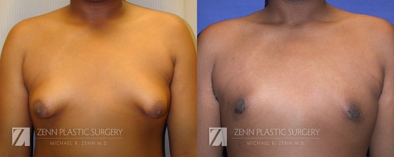 Gynecomastia Before & After Gallery - Patient 106400572 - Image 1