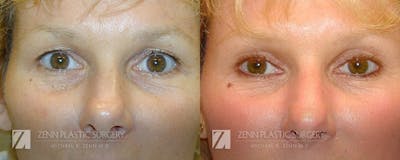 Blepharoplasty / Browlift Before & After Gallery - Patient 106400573 - Image 1