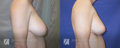 Breast Reduction Before & After Gallery - Patient 106400571 - Image 2