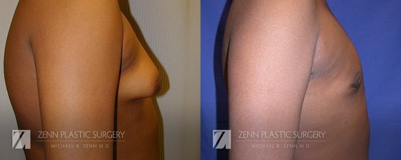 Gynecomastia Before & After Gallery - Patient 106400572 - Image 2