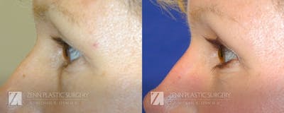 Blepharoplasty / Browlift Before & After Gallery - Patient 106400573 - Image 2
