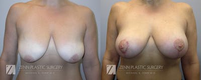 Breast Lift + Implants Before & After Gallery - Patient 106400574 - Image 1