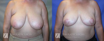Breast Reduction Before & After Gallery - Patient 106400575 - Image 1