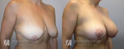 Breast Lift + Implants Before & After Gallery - Patient 106400574 - Image 2
