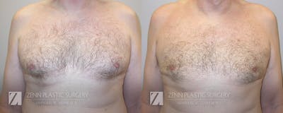 Gynecomastia Before & After Gallery - Patient 106400576 - Image 1