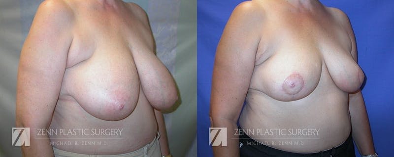 Breast Reduction Before & After Gallery - Patient 106400575 - Image 2