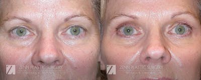 Blepharoplasty / Browlift Before & After Gallery - Patient 106400577 - Image 1