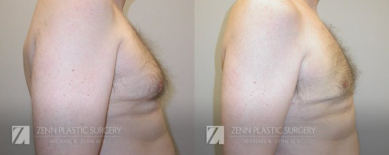 Gynecomastia Before & After Gallery - Patient 106400576 - Image 2
