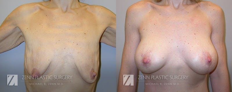 Breast Lift + Implants Before & After Gallery - Patient 106400578 - Image 1