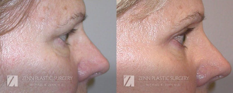 Blepharoplasty / Browlift Before & After Gallery - Patient 106400577 - Image 2