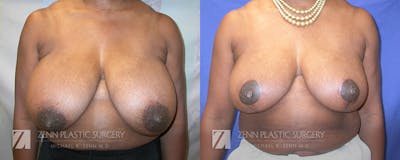 Breast Reduction Before & After Gallery - Patient 106400579 - Image 1