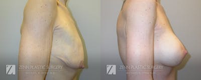 Breast Lift + Implants Before & After Gallery - Patient 106400578 - Image 2