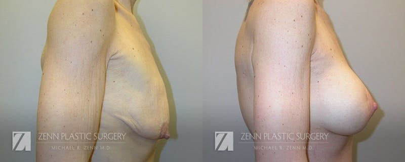 Breast Lift + Implants Before & After Gallery - Patient 106400578 - Image 2