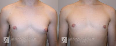 Gynecomastia Before & After Gallery - Patient 106400581 - Image 1