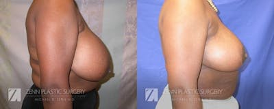 Breast Reduction Before & After Gallery - Patient 106400579 - Image 2