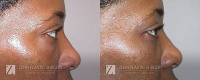 Blepharoplasty / Browlift Before & After Gallery - Patient 106400582 - Image 1
