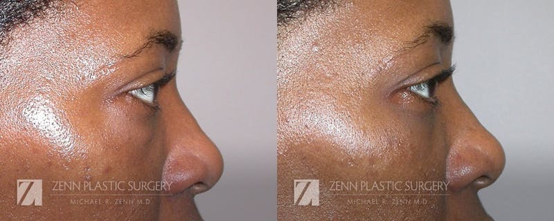 Blepharoplasty / Browlift Before & After Gallery - Patient 106400582 - Image 1