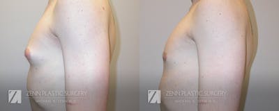Gynecomastia Before & After Gallery - Patient 106400581 - Image 2