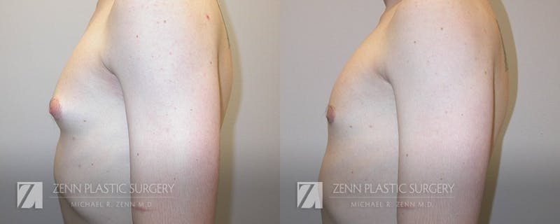 Gynecomastia Before & After Gallery - Patient 106400581 - Image 2