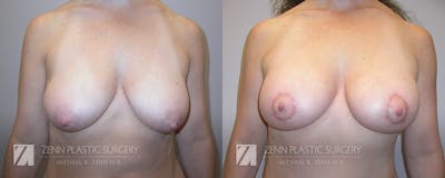 Breast Lift + Implants Before & After Gallery - Patient 106400583 - Image 1