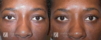 Blepharoplasty / Browlift Before & After Gallery - Patient 106400582 - Image 2