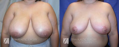 Breast Reduction Before & After Gallery - Patient 106400584 - Image 1
