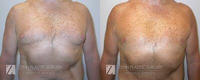 Gynecomastia Before & After Gallery - Patient 106400586 - Image 1