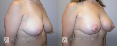 Breast Lift + Implants Before & After Gallery - Patient 106400583 - Image 2