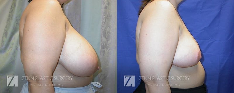 Breast Reduction Before & After Gallery - Patient 106400584 - Image 2
