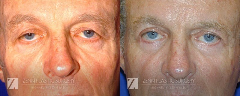 Blepharoplasty / Browlift Before & After Gallery - Patient 106400585 - Image 1