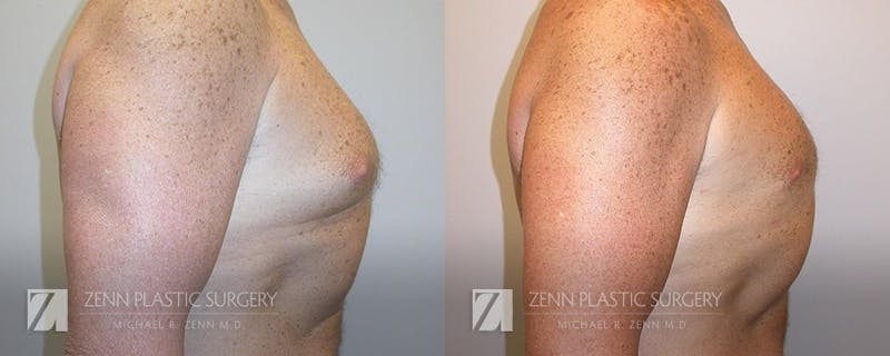 Gynecomastia Before & After Gallery - Patient 106400586 - Image 2