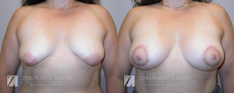 Breast Lift + Implants Before & After Gallery - Patient 106400593 - Image 1