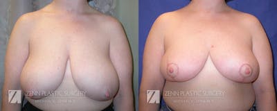 Breast Reduction Before & After Gallery - Patient 106400594 - Image 1