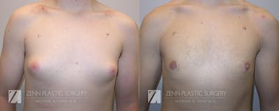 Gynecomastia Before & After Gallery - Patient 106400595 - Image 1