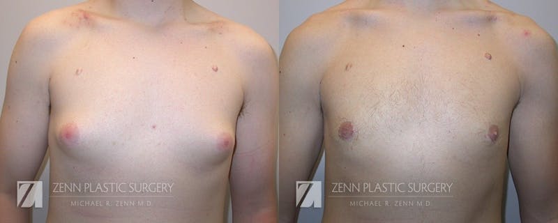 Gynecomastia Before & After Gallery - Patient 106400595 - Image 1