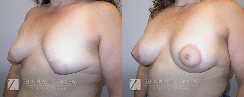 Breast Lift + Implants Before & After Gallery - Patient 106400593 - Image 2