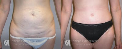 Tummy Tuck Before & After Gallery - Patient 106400596 - Image 1
