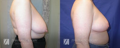 Breast Reduction Before & After Gallery - Patient 106400594 - Image 2