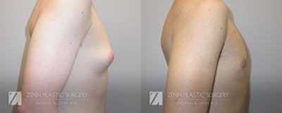 Gynecomastia Before & After Gallery - Patient 106400595 - Image 2