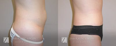 Tummy Tuck Before & After Gallery - Patient 106400596 - Image 2